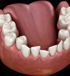 a digital illustration of crowded teeth