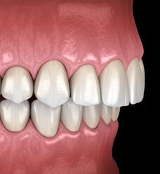 a digital illustration of a mouth with overbite