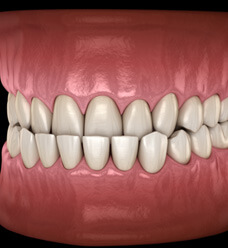 a digital illustration of a mouth with underbite