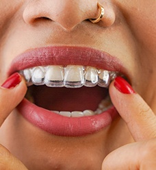 Closeup of patient putting on clear aligner