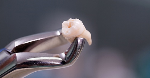 Extracted molar held by forceps