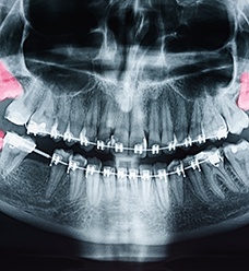  X-ray with 4 wisdom teeth highlighted in red