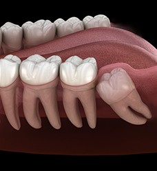  Rendering of lower wisdom tooth growing in sideways pushing other teeth