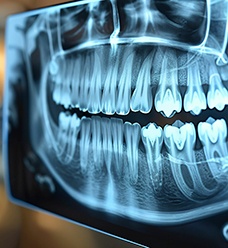 X-ray showing image of impacted wisdom teeth