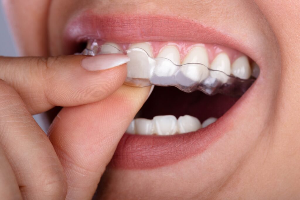 Patient putting on clear aligner