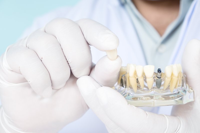 a dentist holding a model of a dental implant