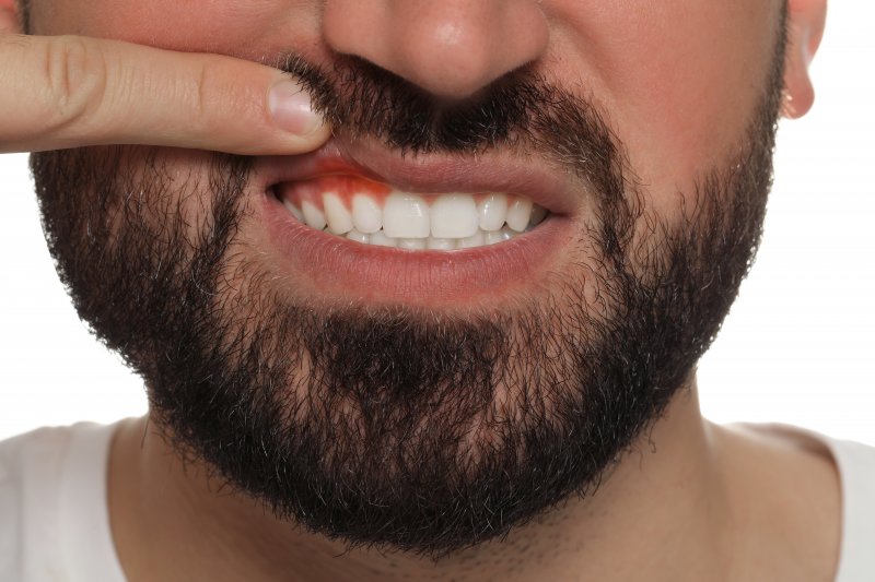 up-close view of man with gum disease