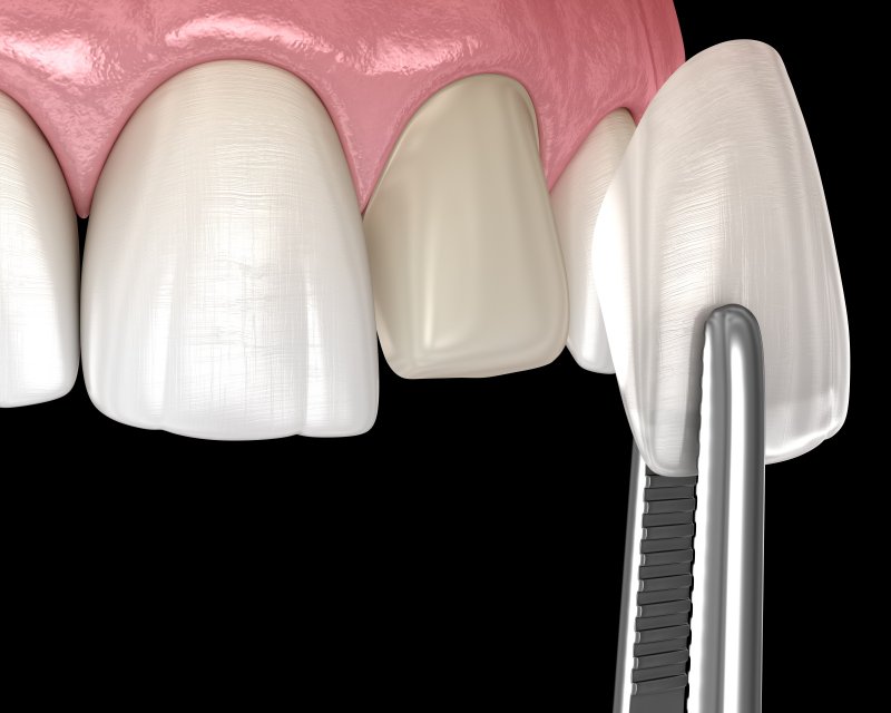 A 3D illustration of a patient getting veneers